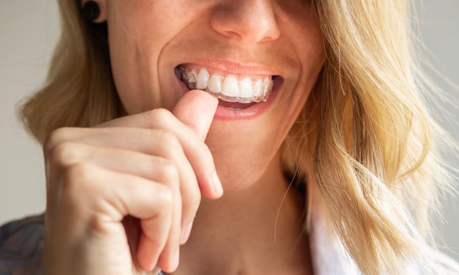A woman with white teeth slides a clear aligner on to her top teeth.