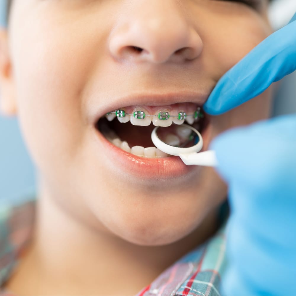 A closeup of a child's mouth with braces on their top teeth.