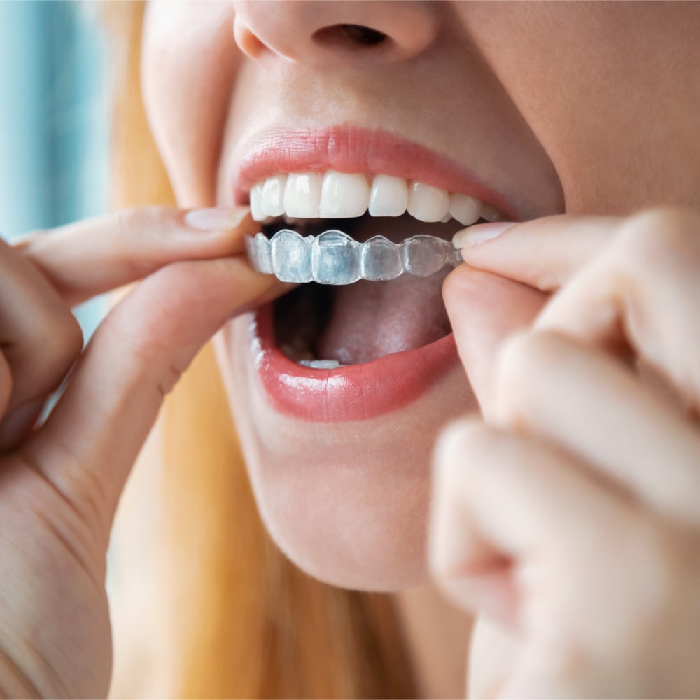 Closeup of a person about to put a clear aligner tray on their top teeth.