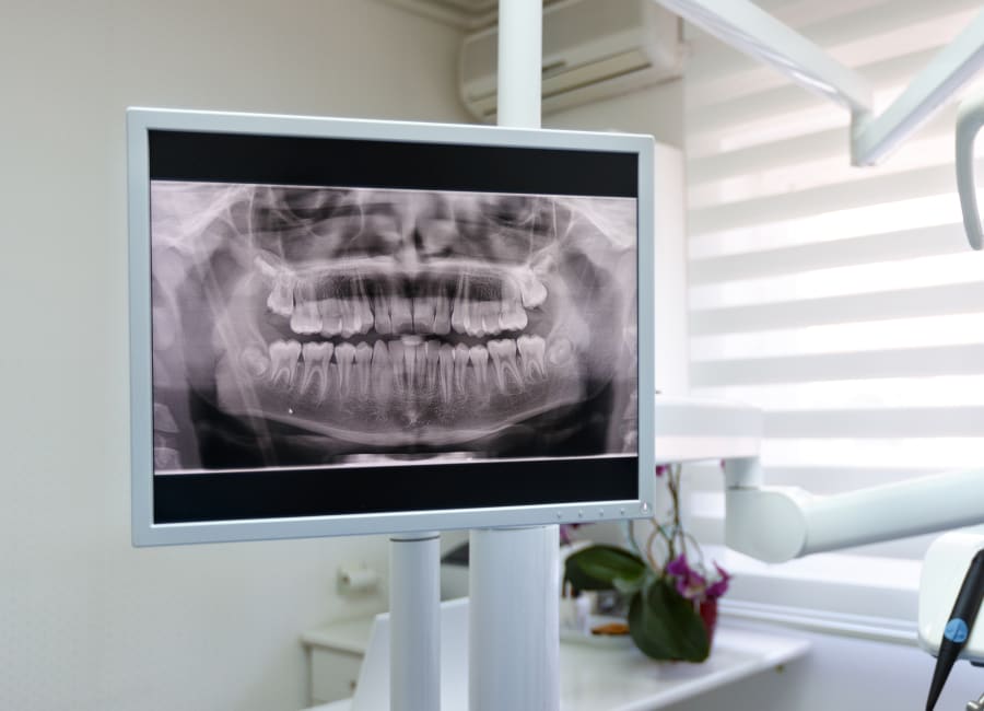 Image of a panoramic X-ray being shown on a treatment room screen.