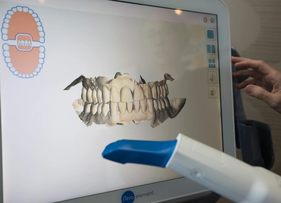 iTero screen showing patient scan, and an iTero wand in the forefront.