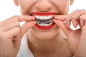 What To Expect During The First Week of Invisalign Treatment