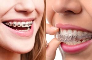 Metal Braces vs. Invisalign