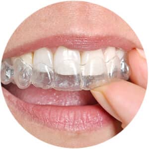 Invisalign